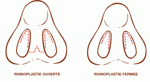 Les différentes cicatrices pour réaliser une rhinoplastie
