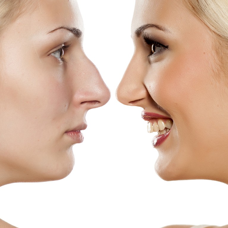 Rhinoplastie : Les suites opératoires - Rhinoplastie.ch