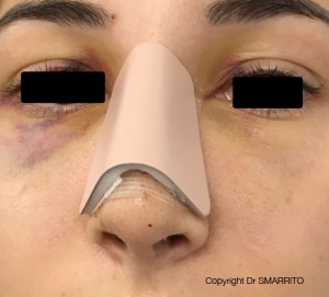 Attelle post-opératoire après rhinoplastie