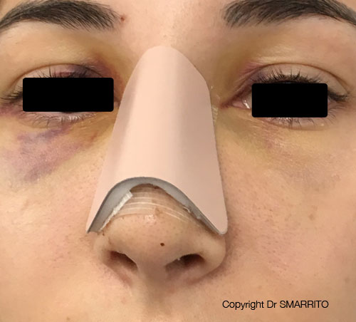 Comment nettoyer son nez après une rhinoplastie ? Nez bouché et nettoyage