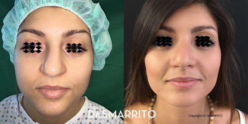 Rhinoplastie : Corriger une pointe disgracieuse - Rhinoplastie.ch